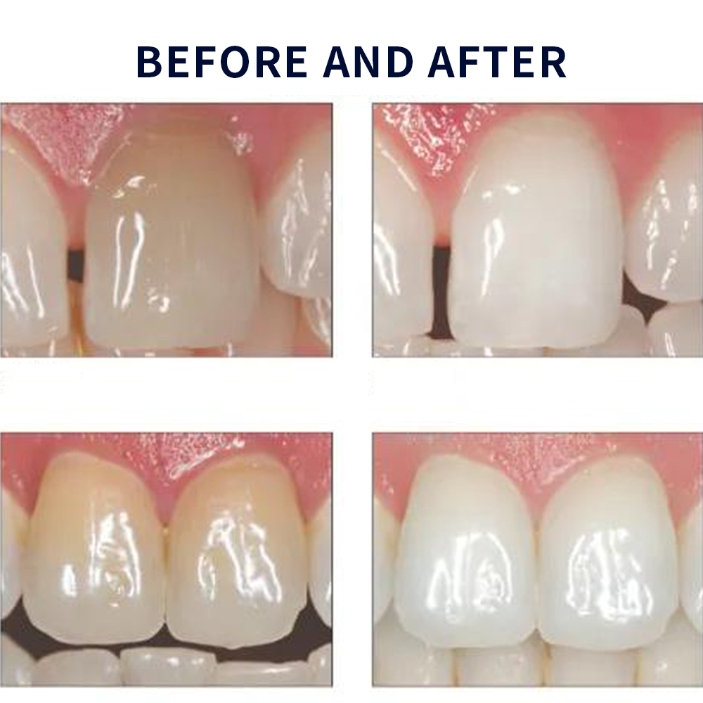 Opalescence Whitening 20% PF 2 - đánh giá và giá Teeth Whitening Bleaching Kit