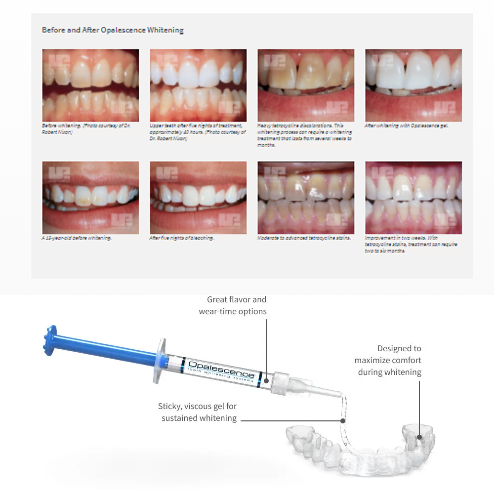 Opalescence Whitening 20% PF 2 - đánh giá và giá Teeth Whitening Bleaching Kit