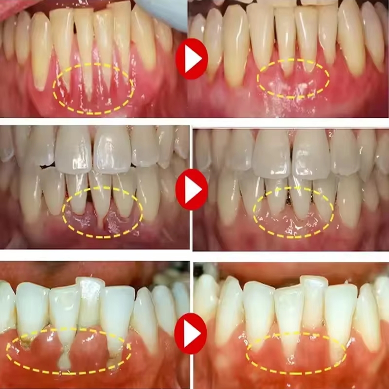 Teeth Whitening Gel Gum Repair - đánh giá và giá Teeth Whitening Gel