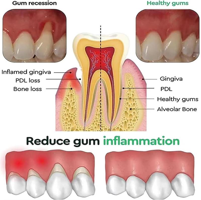 Teeth Whitening Gel Gum Repair - đánh giá và giá Teeth Whitening Gel