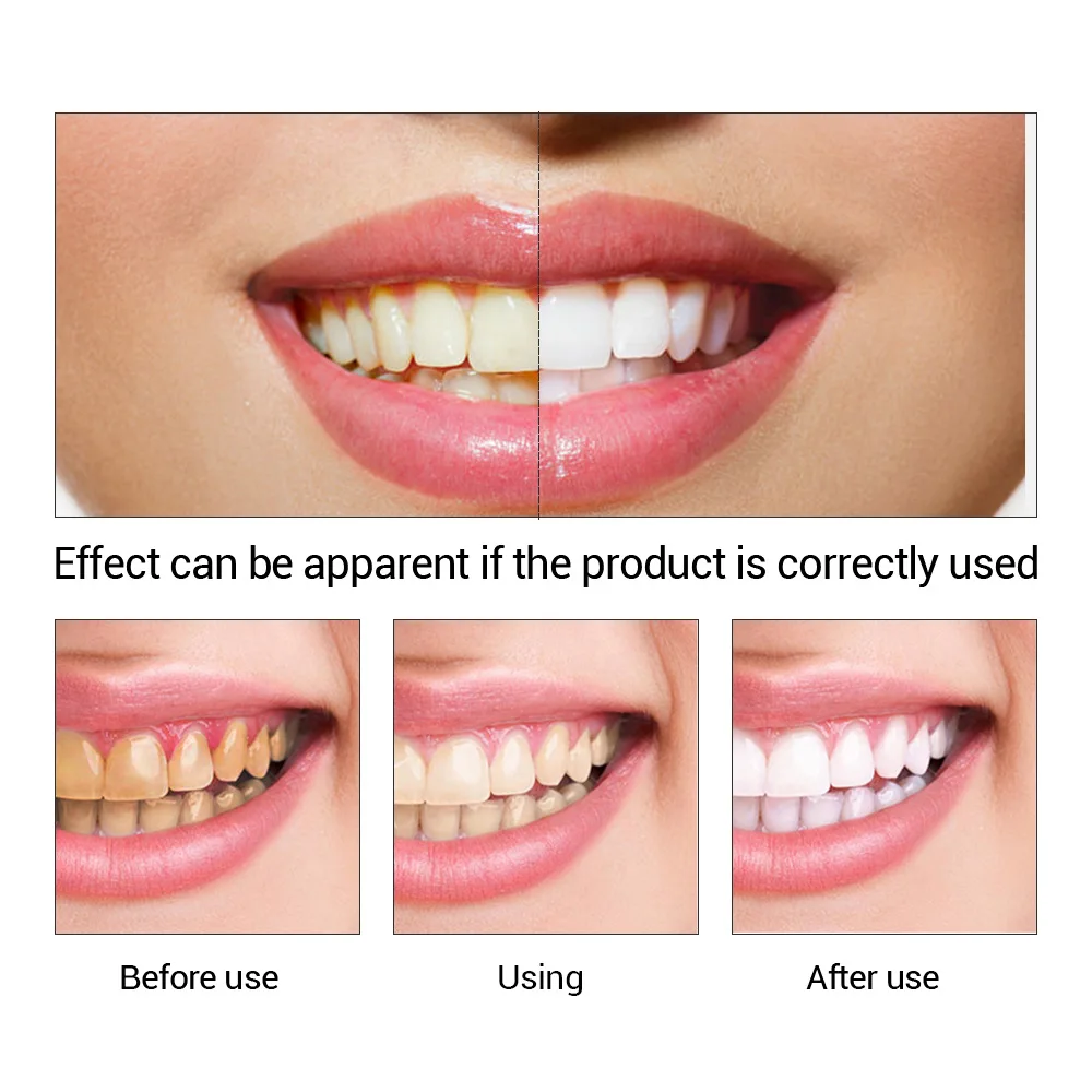 FTEENPLY Làm Trắng Răng Tinh C - đánh giá và giá Teeth Whitening Procedure
