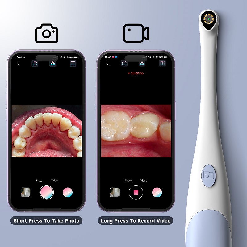 Oral Endoscope Camera 1440P Ph - đánh giá và giá Teeth Whitening Video