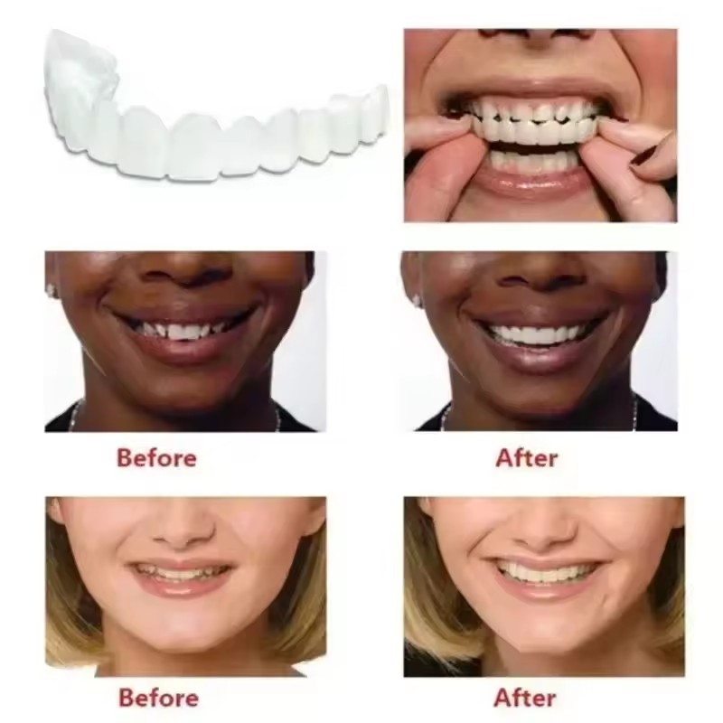 Teeth Veneers Whitening Dentur - đánh giá và giá Teeth Whitening Procedure