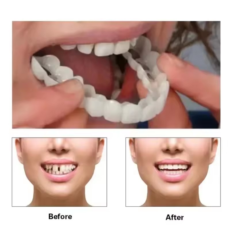 Teeth Veneers Whitening Dentur - đánh giá và giá Teeth Whitening Procedure