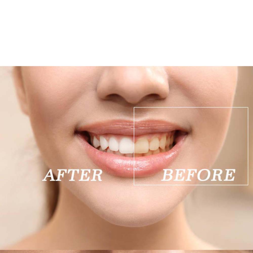 Chất Lượng Hàng Đầu Peroxide L - đánh giá và giá Teeth Whitening Gel